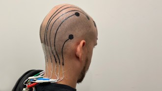 A man's scalp with several dots of ink sprayed on and lines of ink connecting the dots to wires taped to his neck.